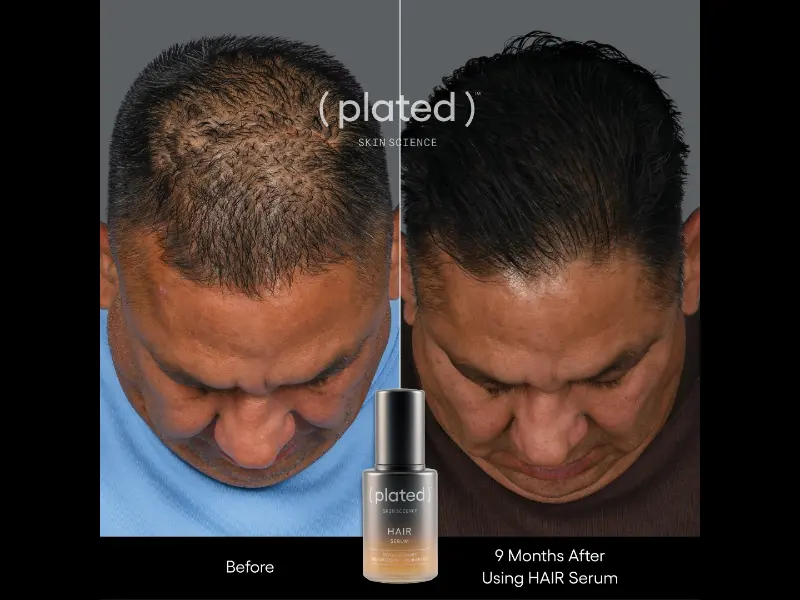 HAIR BA after 9 months